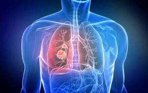 Lung cancer (lung carcinoma)