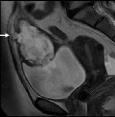 Urinary duct cancer on MRI