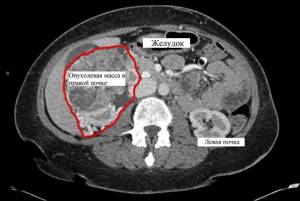 Cancer on CT scan