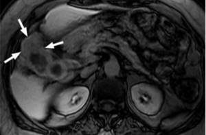 gallbladder cancer on MRI