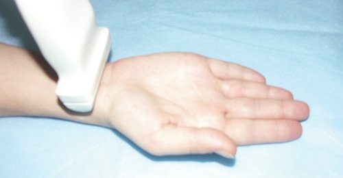 The location of the ultrasound sensor when examining the palmar surface of the wrist and flexor tendons