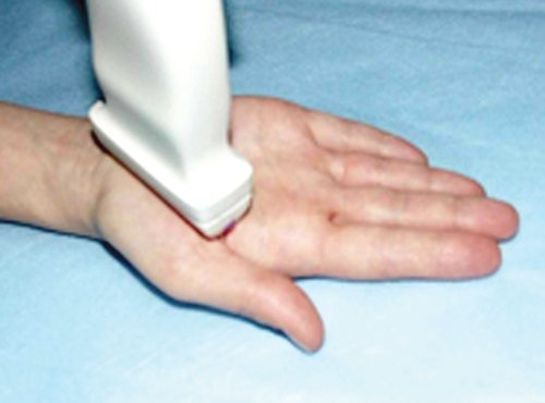 The location of the ultrasound sensor when examining the thenar muscles of the hand