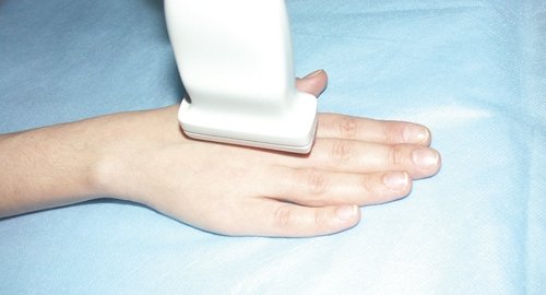 The location of the ultrasound sensor when examining the dorsum of the hand (longitudinal scanning)