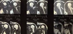 interpretation of MRI images of the shoulder