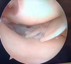 tear of the internal meniscus of the knee joint
