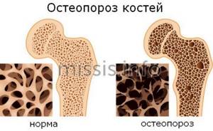 Развитие остеопороза костей