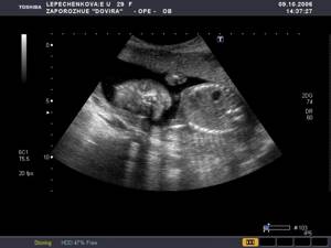 Baby in the second trimester