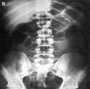 Abdominal x-ray
