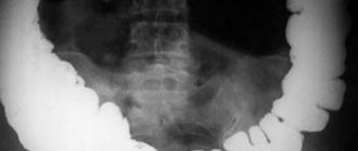 Abdominal x-ray