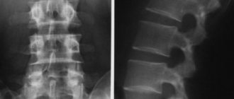 X-ray or MRI of the spine – which is better?