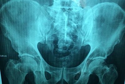 X-ray of the pelvic bones
