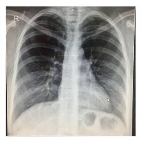 X-ray of the lungs, fluorography