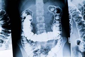 X-ray of the small intestine