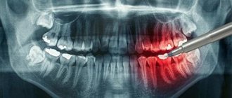 X-ray of teeth