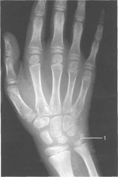 Рентгенограмма лучезапястного сустава (10-11 лет).