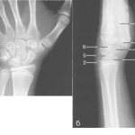 X-ray of the wrist joint (12-13 years).