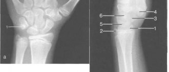 Рентгенограмма лучезапястного сустава (12—13 лет).