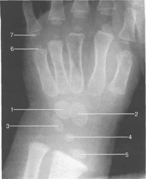 Рентгенограмма лучезапястного сустава (3—4 года).