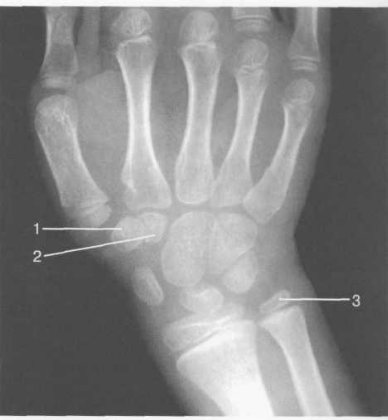 Рентгенограмма лучезапястного сустава (8-9 лет).