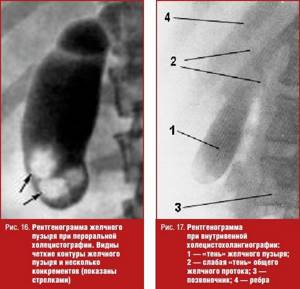 Рентгенограмма желчного пузыря при пероральной холецистографии