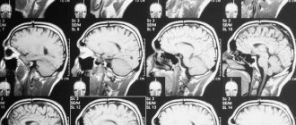Brain MRI results