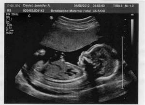 Fetal fetometry results