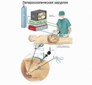 Scheme of laparoscopic surgery