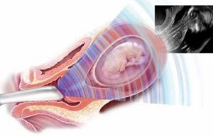 Scheme of transvaginal ultrasound during pregnancy
