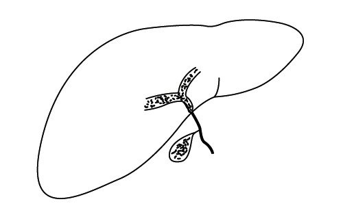 Schematic representation of bile duct atresia: extrahepatic