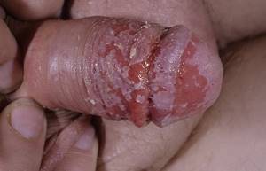 symptoms of yeast in a smear in men