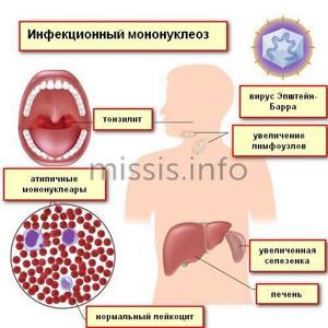 Symptoms of infectious mononucleosis