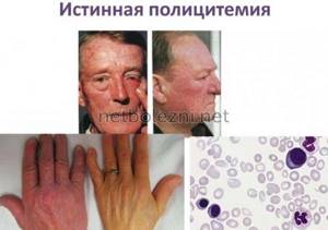 Symptoms of polycythemia disease