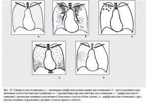pulmonary dissemination syndrome