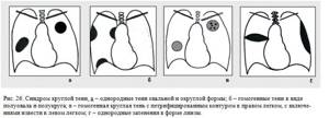 round shadow syndrome in the lungs