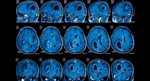 MRI images of the brain
