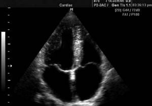 Echocardiography image of a child