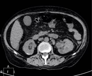 Kidney CT scan