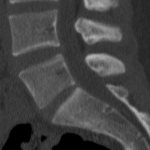 CT scan of the cervical spine