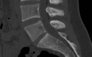 CT scan of the cervical spine