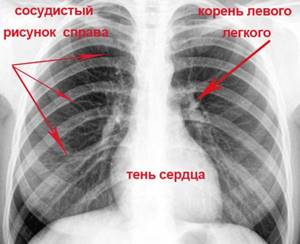 lung image