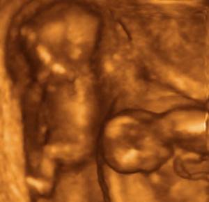 Photo of multiple pregnancy