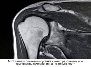 MRI image of the shoulder