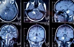 MRI image of a brain tumor