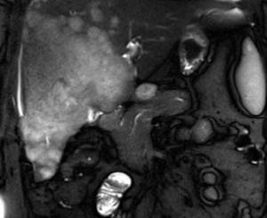 Снимок печени на МРТ: гепатоцеллюлярный рак