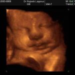 3D ultrasound image of the fetus at 38 weeks of pregnancy