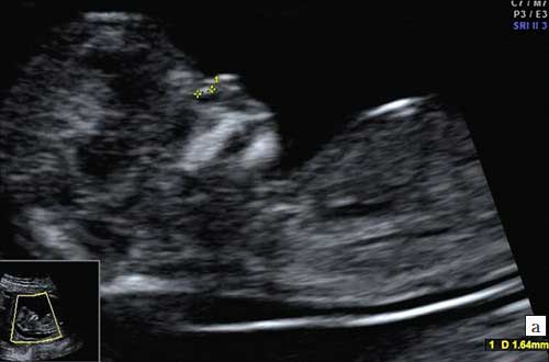 Ultrasound image: nasal bone hypoplasia