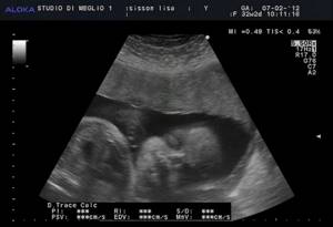 Ultrasound image of a baby at 38 weeks of pregnancy
