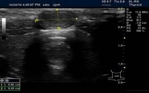 Sonography of the thyroid gland in a child