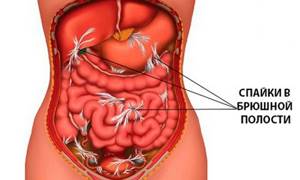 adhesions in the intestinal area