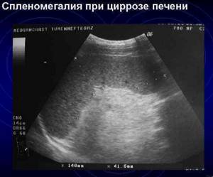 Splenomegaly in cirrhosis on ultrasound